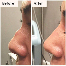 nose reshape with fillers queens